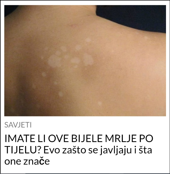 IMATE LI OVE BIJELE MRLJE PO TIJELU? Evo zašto se javljaju i šta one znače