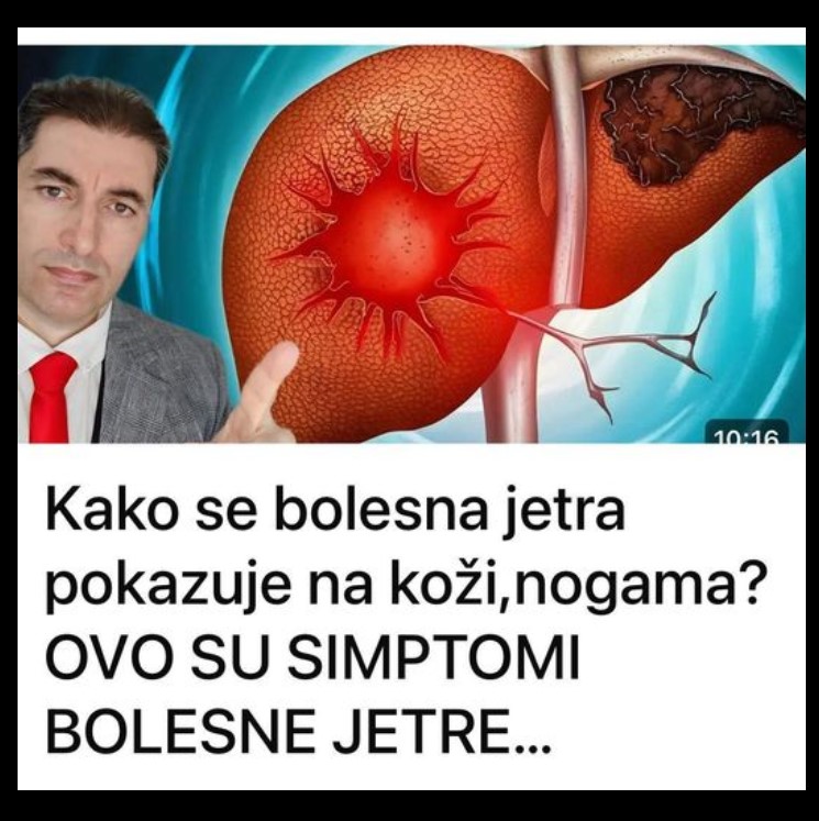 Kako se bolesna jetra pokazuje na koži,nogama? OVO SU SIMPTOMI BOLESNE JETRE…