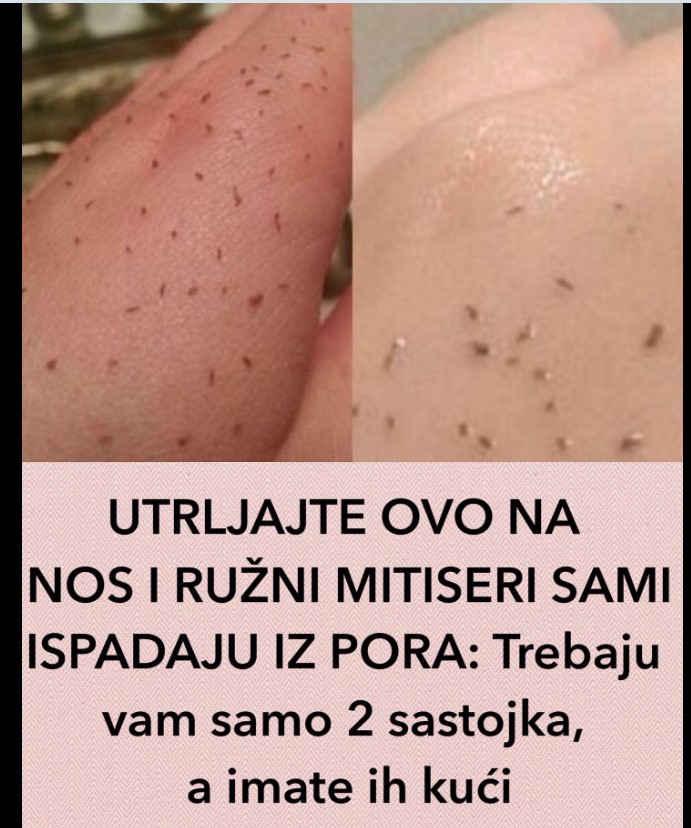 UTRLJAJTE OVO NA NOS I RUŽNI MITISERI SAMI ISPADAJU IZ PORA: Trebaju vam samo 2 sastojka, a imate ih kući