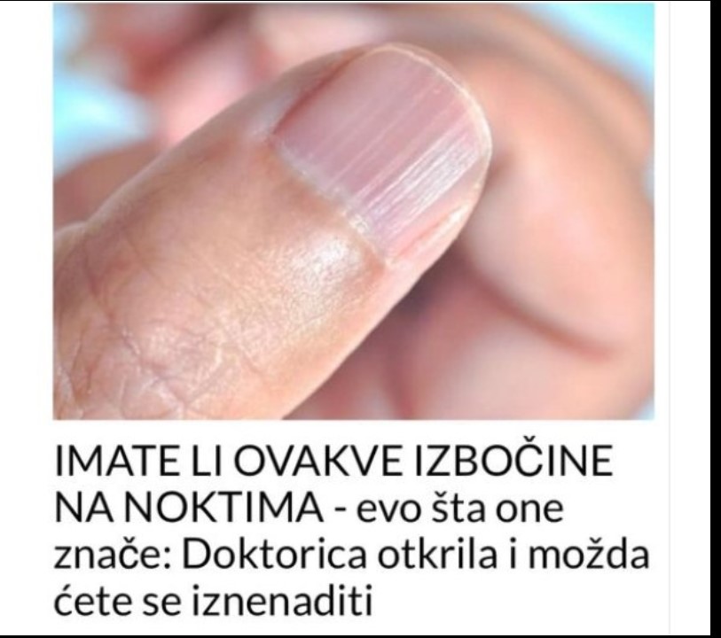 IMATE LI OVAKVE IZBOČINE NA NOKTIMA – Evo Šta One Znače: Doktorica Otkrila I Možda Ćete Se Iznenaditi