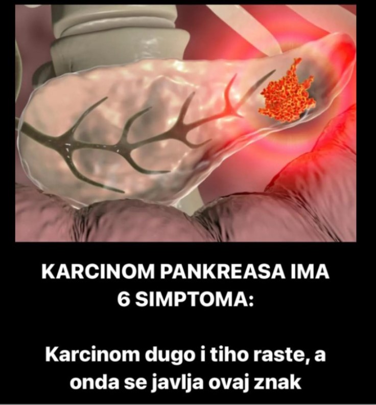 KARCINOM PANKREASA IMA 6 SIMPTOMA: Karcinom dugo i tiho raste, a onda se javlja ovaj znak