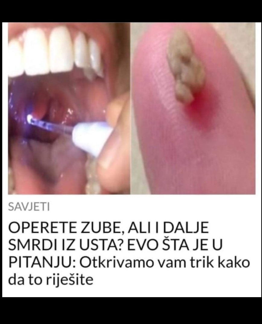 OPERETE ZUBE, ALI I DALJE SMRDI IZ USTA? EVO ŠTA JE U PITANJU: Otkrivamo vam trik kako da to riješite