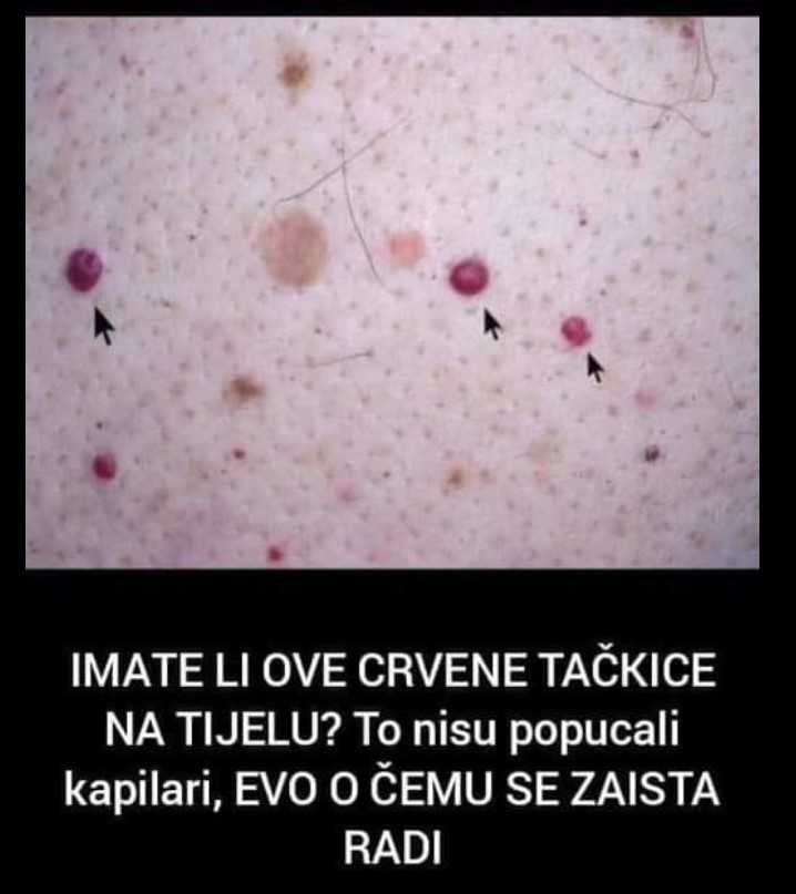 IMATE LI OVE CRVENE TAČKICE NA TIJELU? To nisu popucali kapilari, EVO O ČEMU SE ZAISTA RADI