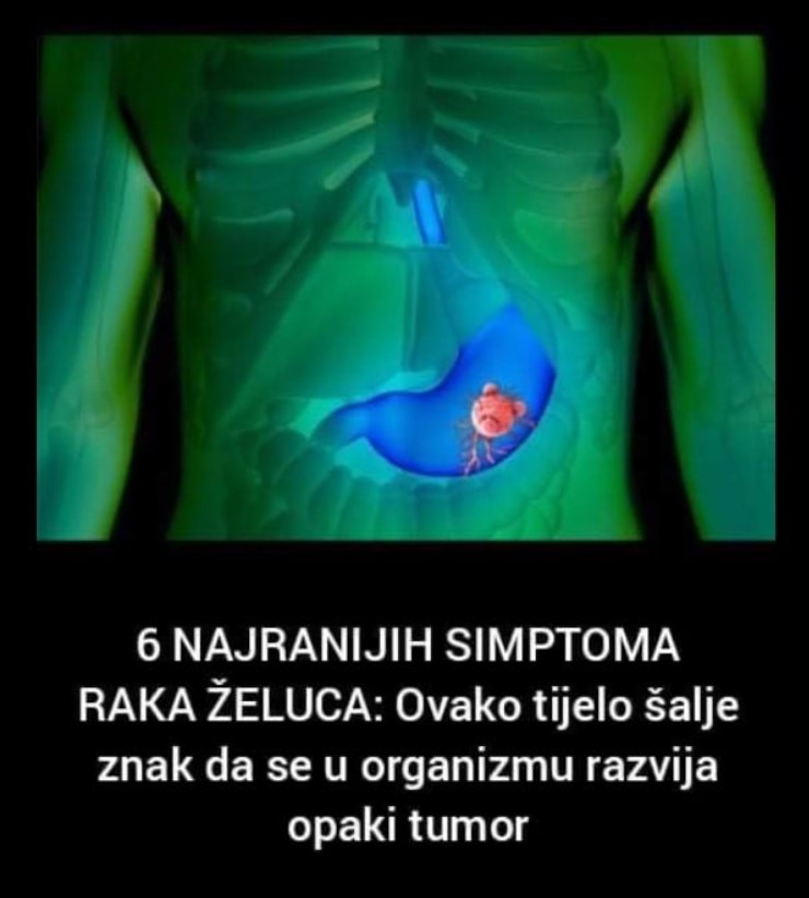 6 NAJRANIJIH SIMPTOMA RAKA ŽELUCA: Ovako tijelo šalje znak da se u organizmu razvija opaki tumor!