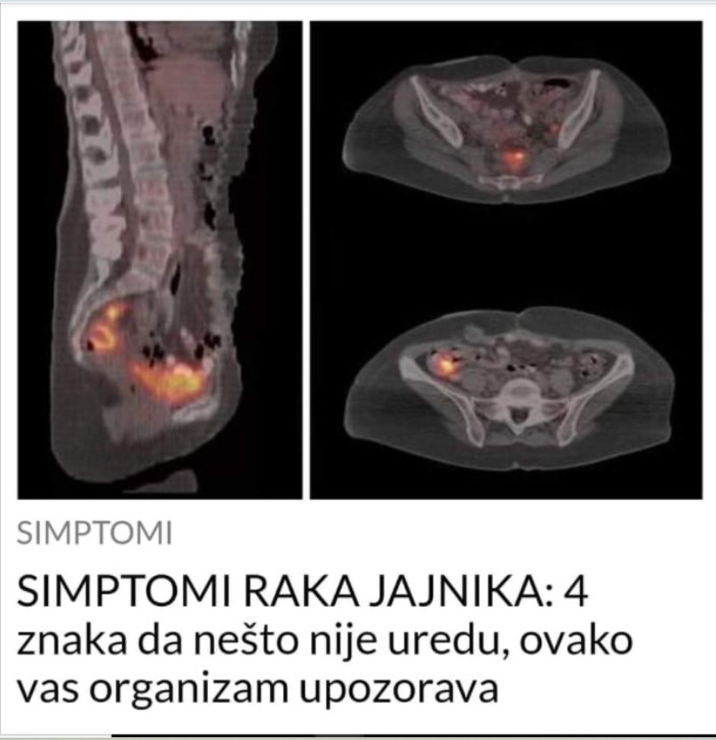 SIMPTOMI RAKA JAJNIKA: 4 znaka da nešto nije uredu, ovako vas organizam upozorava