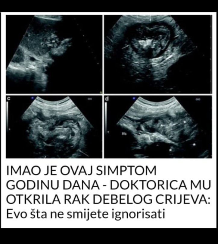 IMAO JE OVAJ SIMPTOM GODINU DANA – DOKTORICA MU OTKRILA RAK DEBELOG CRIJEVA: Evo šta ne smijete ignorisati