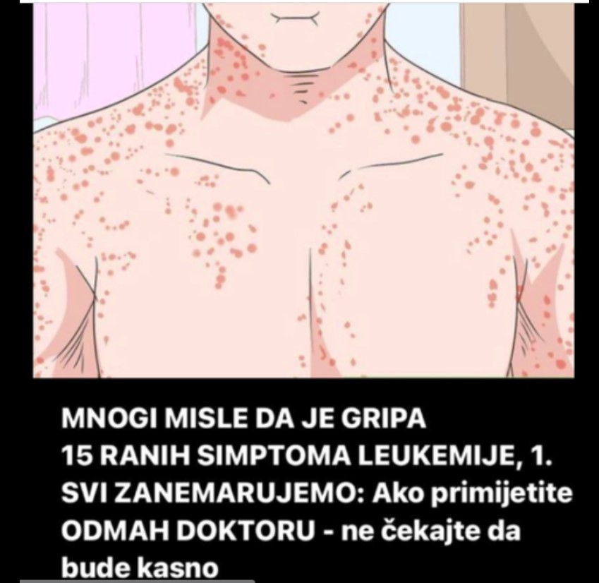 15 RANIH SIMPTOMA LEUKEMIJE, 1. SVI ZANEMARUJEMO: Ako primijetite ODMAH DOKTORU – ne čekajte da bude kasno