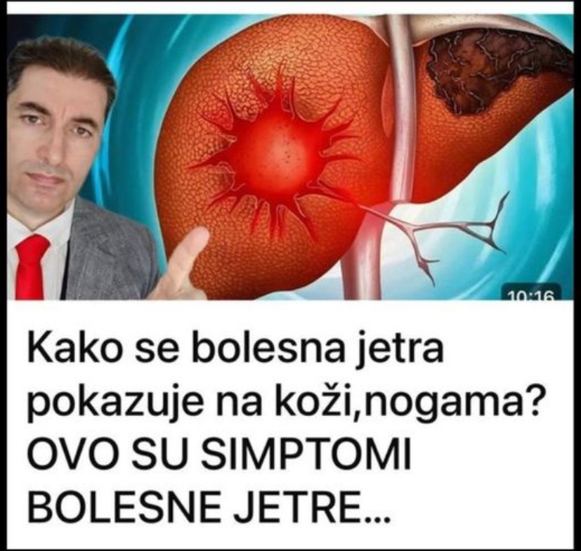 Kako se bolesna jetra pokazuje na koži,nogama? OVO SU SIMPTOMI BOLESNE JETRE…