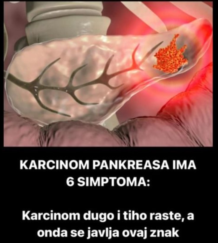 KARCINOM PANKREASA IMA 6 SIMPTOMA: Karcinom dugo i tiho raste, a onda se javlja ovaj znak