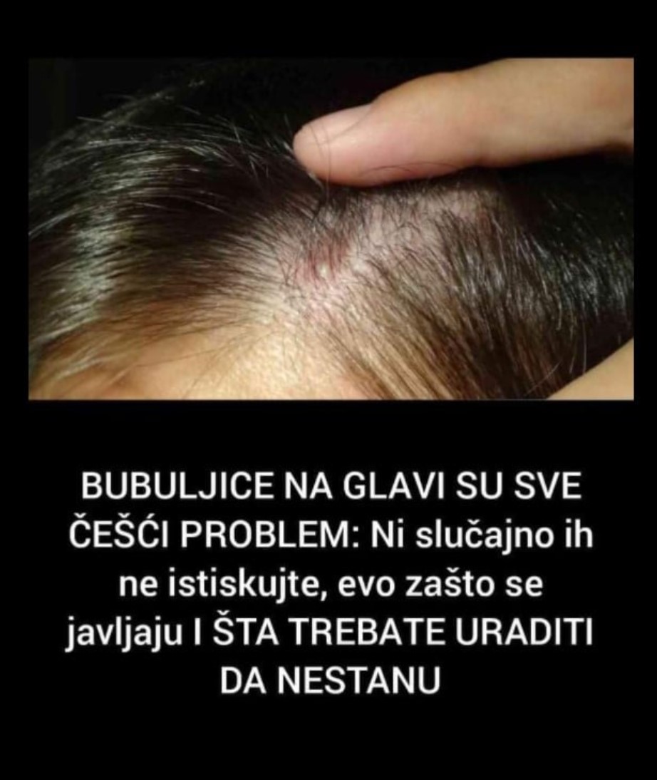 BUBULJICE NA GLAVI SU SVE ČEŠĆI PROBLEM: Ni slučajno ih ne istiskujte, evo zašto se javljaju I ŠTA TREBATE URADITI DA NESTANU