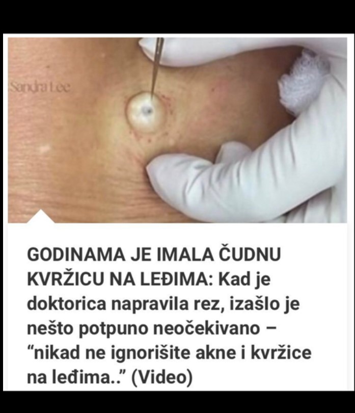 GODINAMA JE IMALA ČUDNU KVRŽICU NA LEĐIMA: Kad je doktorica napravila REZ, IZAŠLO JE NEŠTO ŠTO NIKO NIJE OČEKIVAO! (VIDEO)