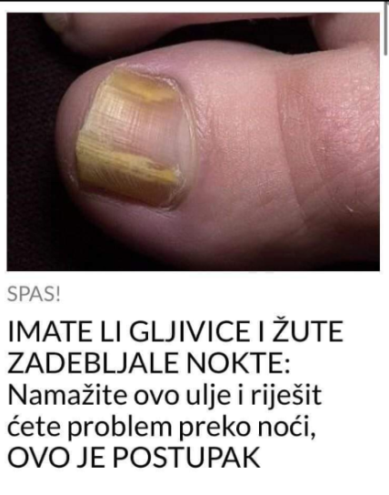 IMATE LI GLJIVICE I ŽUTE ZADEBLJALE NOKTE: Namažite ovo ulje i riješit ćete problem preko noći, OVO JE POSTUPAK