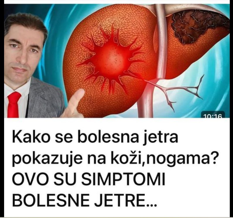 Kako se bolesna jetra pokazuje na koži,nogama? OVO SU SIMPTOMI BOLESNE JETRE…