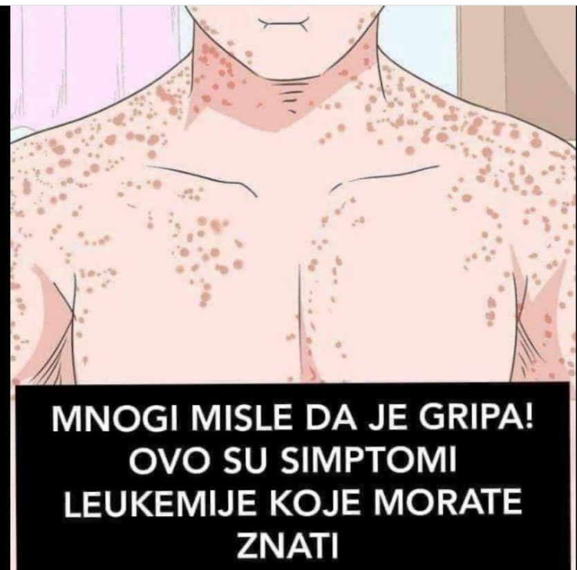 MNOGI MISLE DA JE GRIPA: Ovo su simptomi LEUKEMIJE, primijetite ih prije nego što BUDE KASNO!