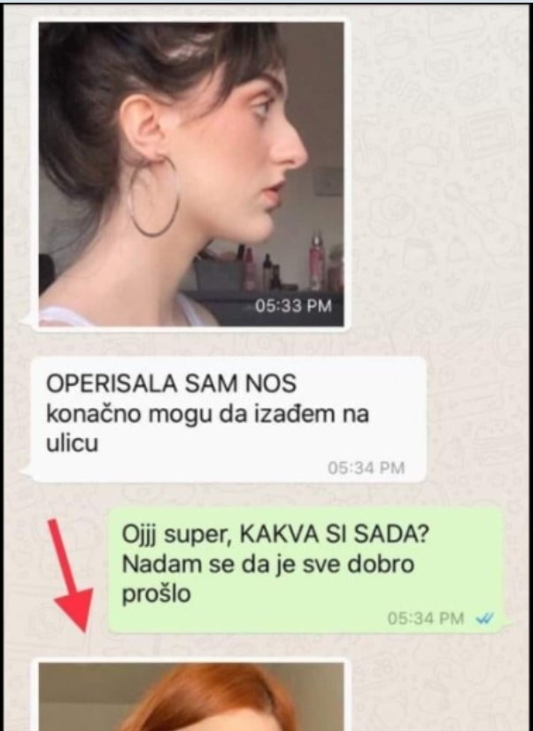 OPERISALA SAM NOS PRIJE MJESEC DANA I SLIKU ODMAH POSLALA PRIJATELJICI: Konačno mogu da izađem na ulicu BEZ STIDA, SAD SAM POTPUNO DRUGAČIJA