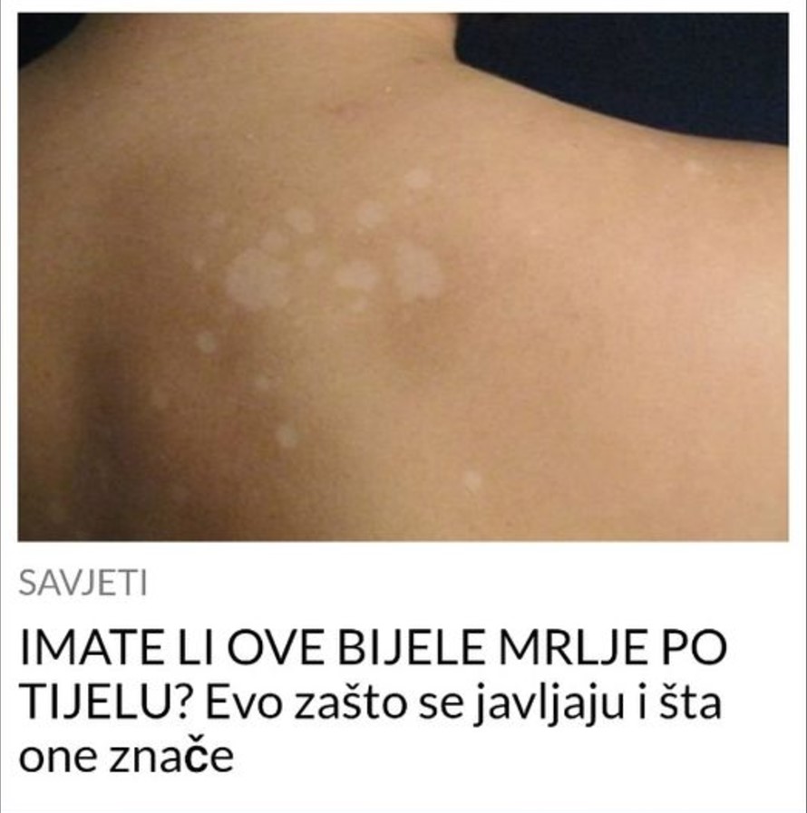 IMATE LI OVE BIJELE MRLJE PO TIJELU? Evo zašto se javljaju i šta one znače