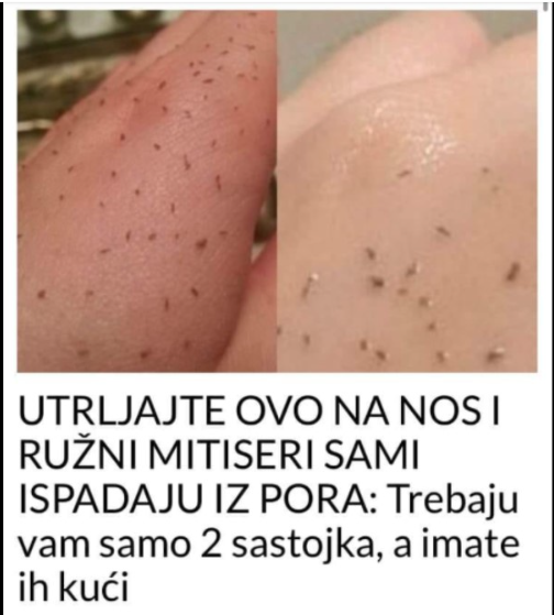 UTRLJAJTE OVO NA NOS I RUŽNI MITISERI SAMI ISPADAJU IZ PORA: Trebaju vam samo 2 sastojka, a imate ih kući