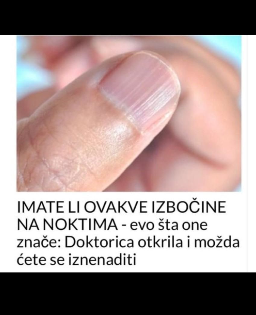 IMATE LI OVAKVE IZBOČINE NA NOKTIMA – evo šta one znače: Doktorica otkrila i možda ćete se iznenaditi