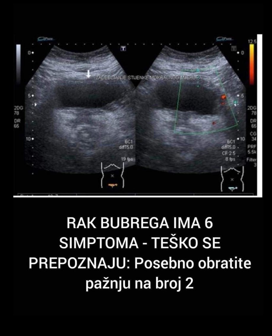 RAK BUBREGA IMA 6 SIMPTOMA – TEŠKO SE PREPOZNAJU: Posebno obratite pažnju na broj 2