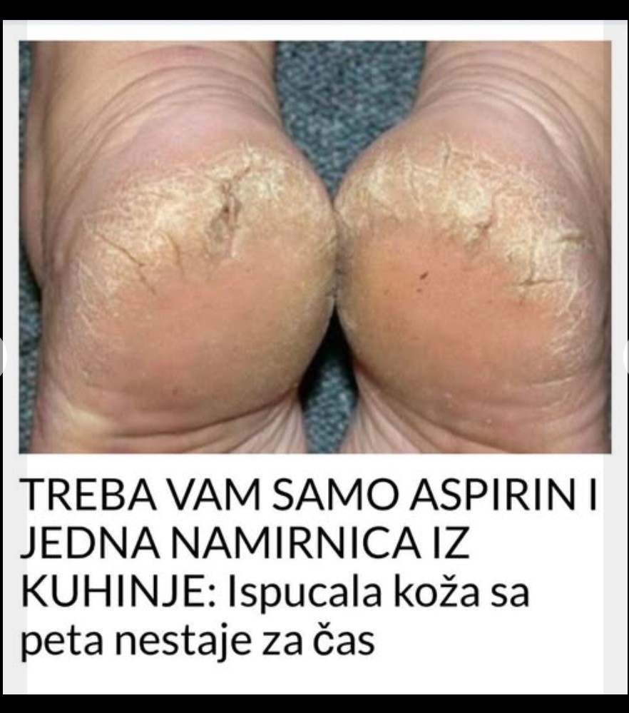 TREBA VAM SAMO ASPIRIN I JEDNA NAMIRNICA IZ KUHINJE: Ispucala koža sa peta nestaje za čas