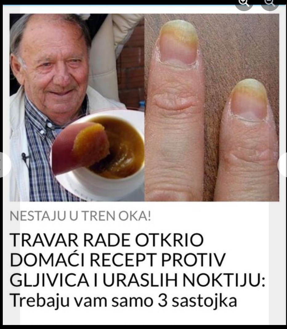 TRAVAR RADE OTKRIO DOMAĆI RECEPT PROTIV GLJIVICA I URASLIH NOKTIJU: Trebaju vam samo 3 sastojka