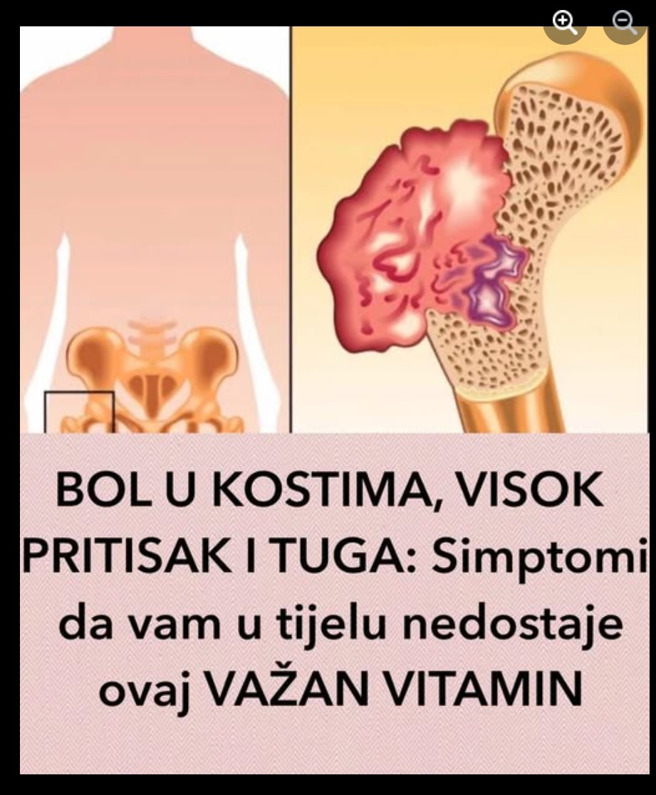 Bol u kostima, visok pritisak i tuga: Simptomi da vam u telu nedostaje ovaj važan vitamin