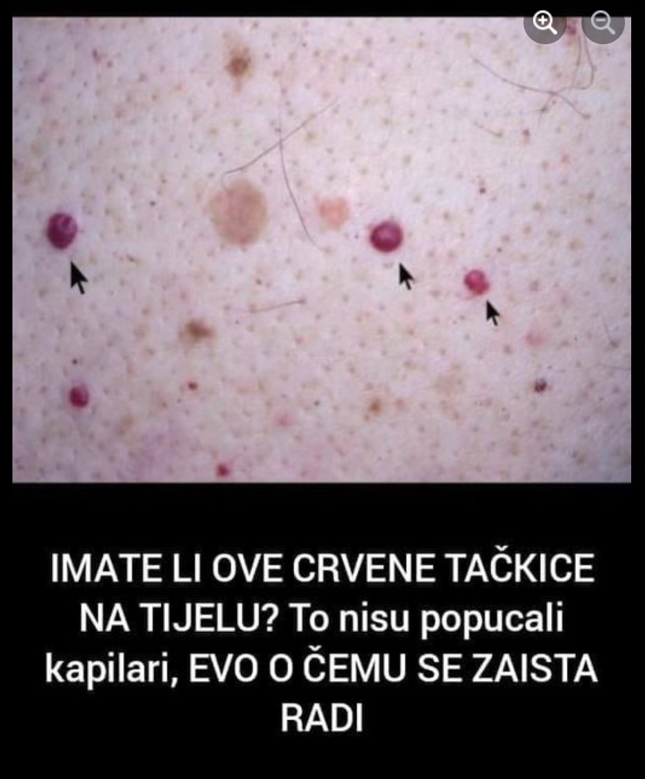 IMATE LI OVE CRVENE TAČKICE NA TIJELU? To Nisu Popucali Kapilari, EVO O ČEMU SE ZAISTA RADI