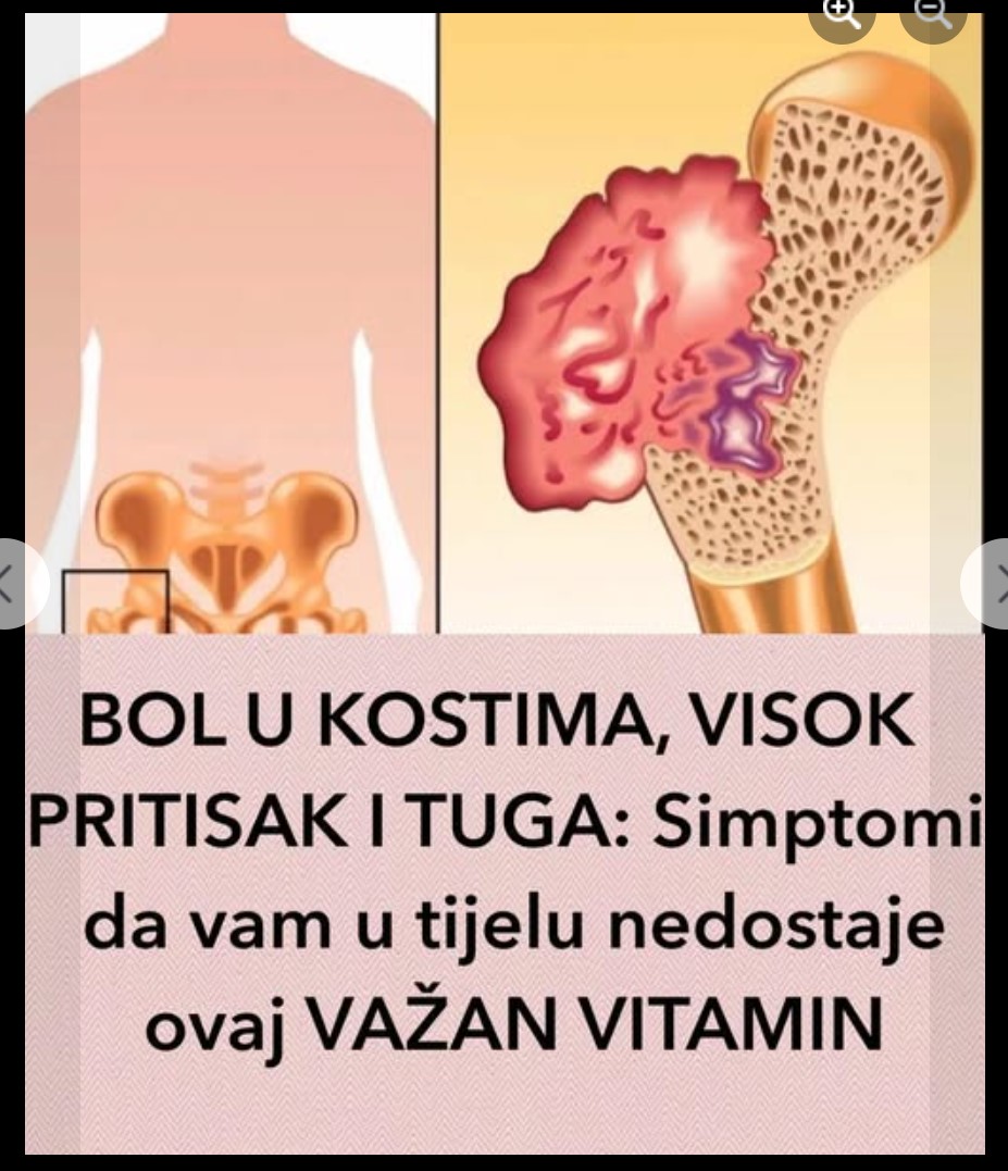 Bol u kostima, visok pritisak i tuga: Simptomi da vam u tijelu nedostaje ovaj važan vitamin