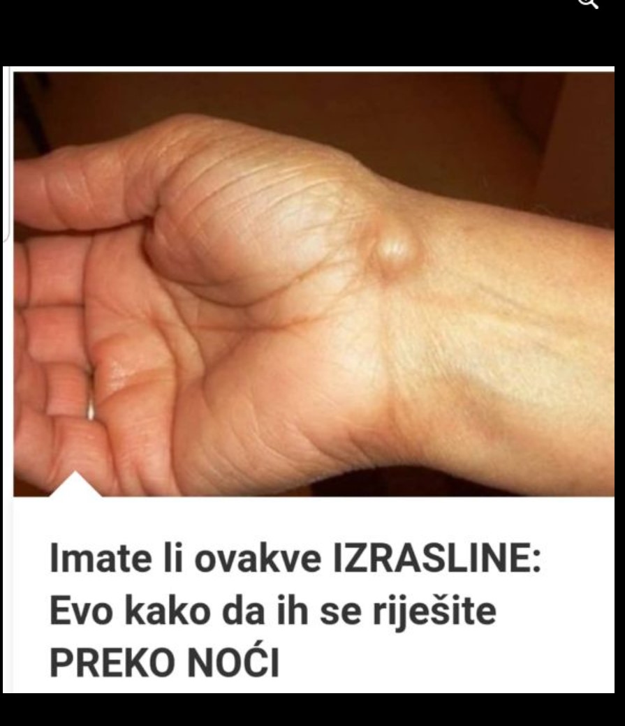 Imate li ovakve IZRASLINE: Evo kako da ih se riješite PREKO NOĆI