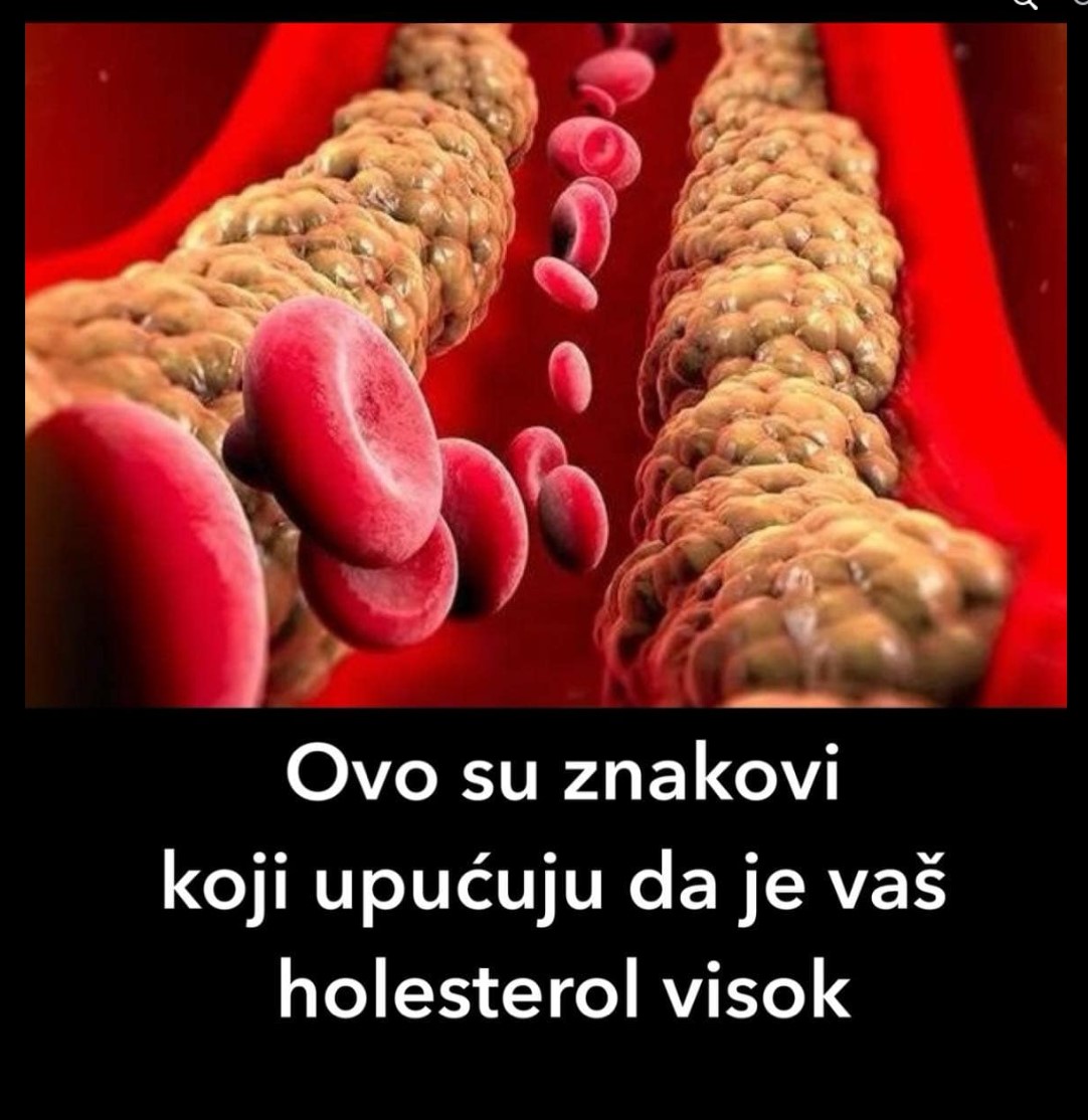 Ovo su znakovi koji upućuju da je vaš holesterol visok