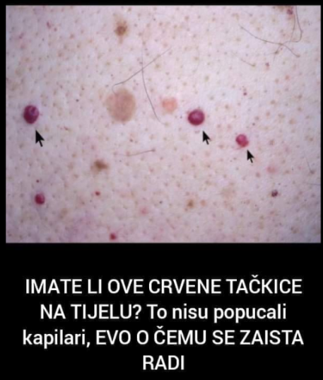 IMATE LI OVE CRVENE TAČKICE NA TIJELU? To nisu popucali kapilari, EVO O ČEMU SE ZAISTA RADI