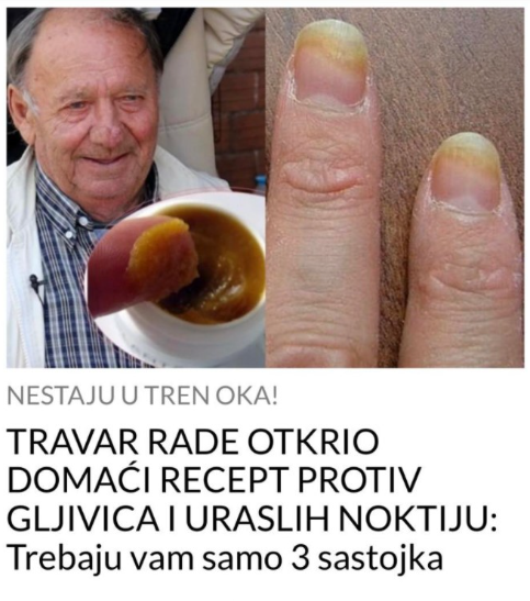 TRAVAR RADE OTKRIO DOMAĆI RECEPT PROTIV GLJIVICA I URASLIH NOKTIJU: Trebaju vam samo 3 sastojka