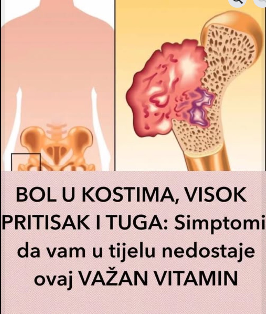 Bol u kostima, visok pritisak i tuga: Simptomi da vam u telu nedostaje ovaj važan vitamin
