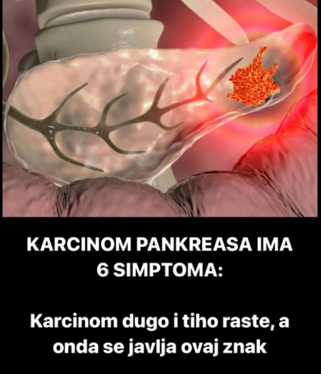 KARCINOM PANKREASA IMA 6 SIMPTOMA: Karcinom dugo i tiho raste, a onda se javlja ovaj znak