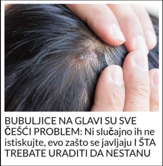 BUBULJICE NA GLAVI SU SVE ČEŠĆI PROBLEM: Ni slučajno ih ne istiskujte, evo zašto se javljaju I ŠTA TREBATE URADITI DA NESTANU