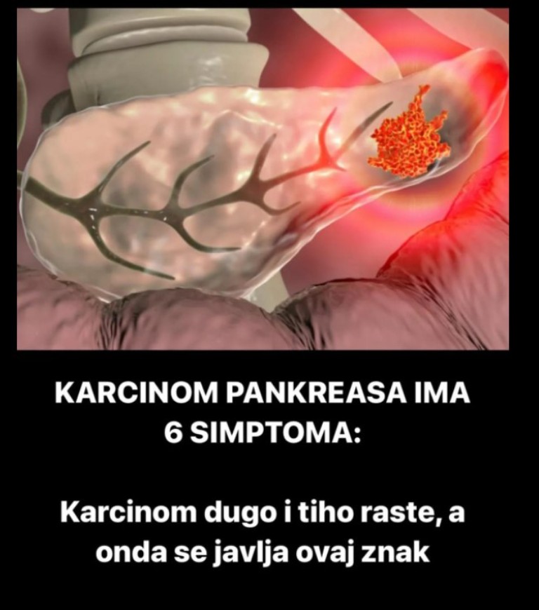 KARCINOM PANKREASA IMA 6 SIMPTOMA: Karcinom dugo i tiho raste, a onda