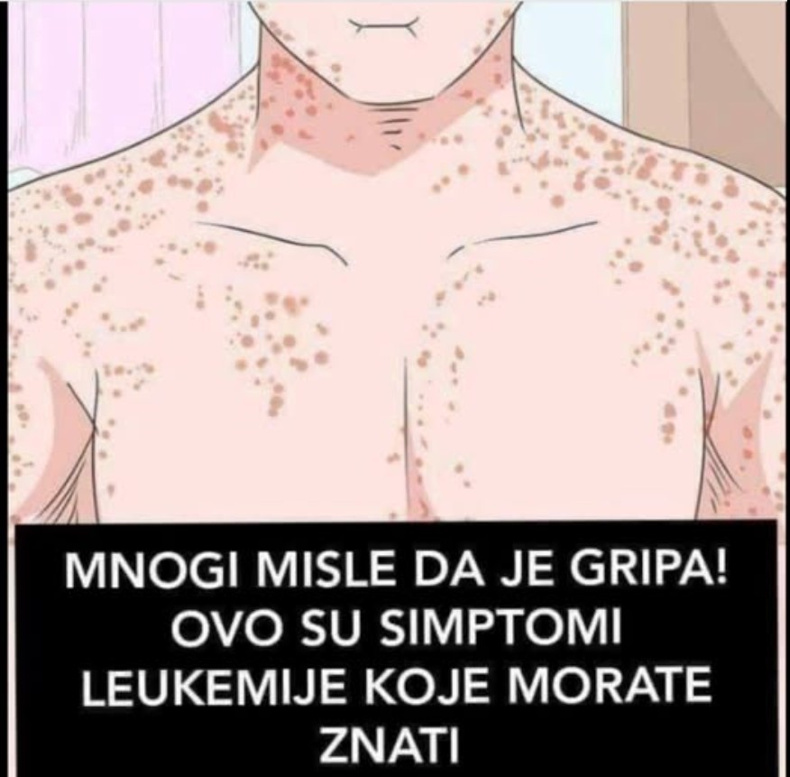 MNOGI MISLE DA JE GRIPA: Ovo su simptomi LEUKEMIJE, primijetite ih prije nego što BUDE KASNO!
