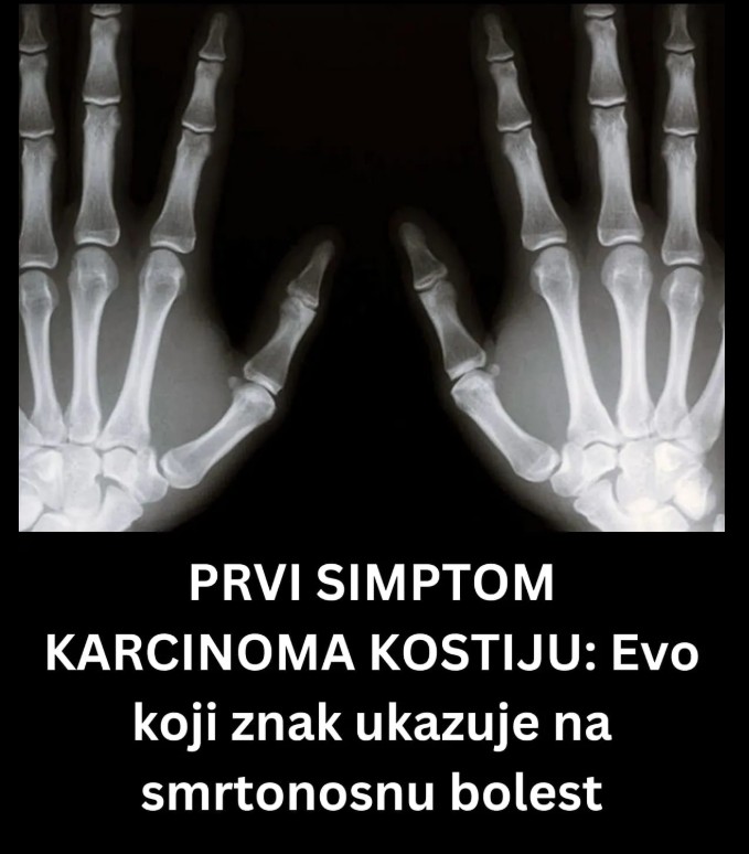 Mogući rani simptomi karcinoma kostiju: Kada se javiti ljekaru
