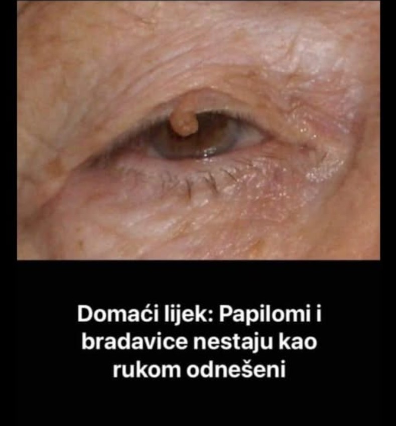 PAPILOMI I BRADAVICE NESTAJU KAO RUKOM ODNEŠENI: Samo koristite OVO, riješite ih se POTPUNO PRIRODNO