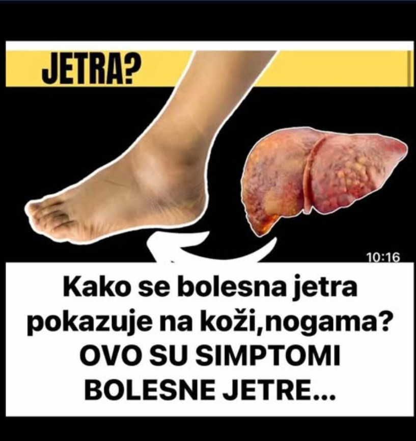 Kako se bolesna jetra pokazuje na koži,nogama? OVO SU SIMPTOMI BOLESNE JETRE…