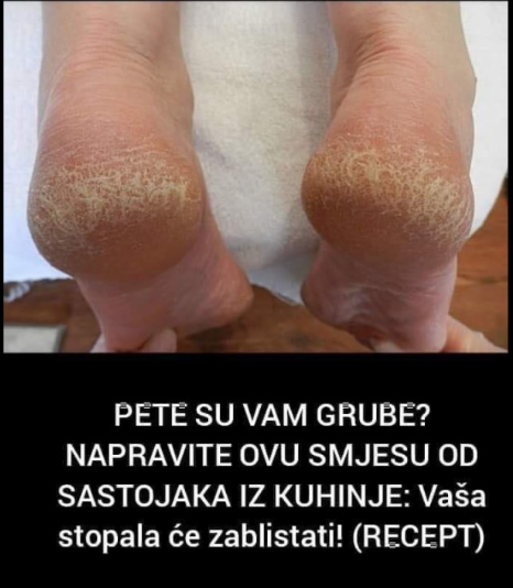 PETE SU VAM GRUBE? NAPRAVITE OVU SMJESU OD SASTOJAKA IZ KUHINJE: Vaša stopala će zablistati! (RECEPT)