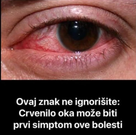 OVAJ SIMPTOM NE SMIJETE IGNORISATI: Crvenilo očiju može da bude PRVI ZNAK OVE BOLESTI!