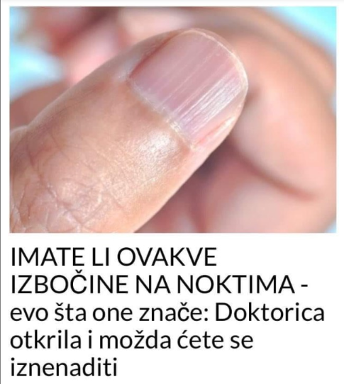 IMATE LI OVAKVE IZBOČINE NA NOKTIMA – evo šta one znače: Doktorica otkrila i možda ćete se iznenaditi