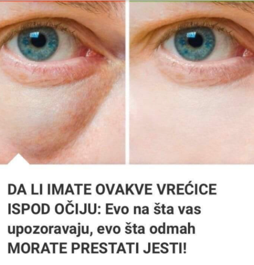 DA LI IMATE OVAKVE VREĆICE ISPOD OČIJU: Evo na šta vas upozoravaju, evo šta odmah MORATE PRESTATI JESTI!