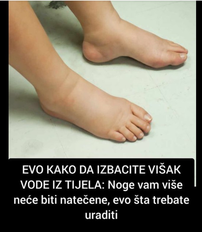 Kako prepoznati i smanjiti zadržavanje vode u organizmu