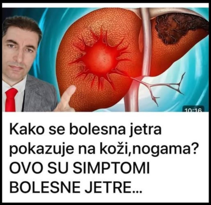 Kako se bolesna jetra pokazuje na koži,nogama? OVO SU SIMPTOMI BOLESNE JETRE…