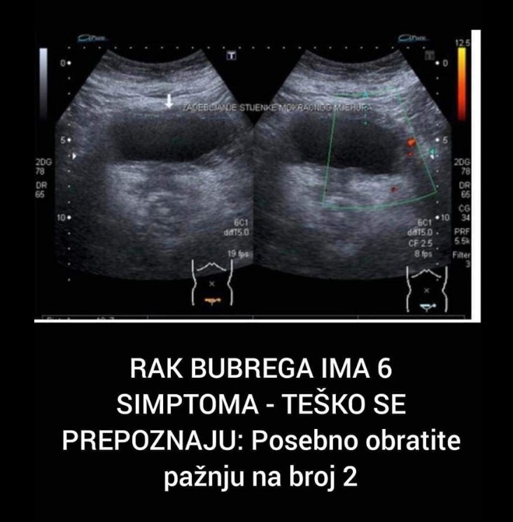 Rak bubrega: Rani simptomi, faktori rizika i važnost pravovremene dijagnoze
