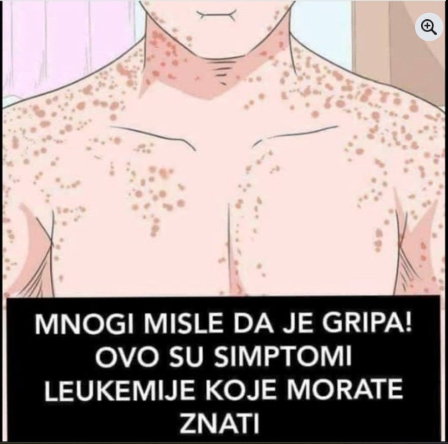 MNOGI MISLE DA JE GRIPA: Ovo su simptomi LEUKEMIJE, primijetite ih prije nego što BUDE KASNO!