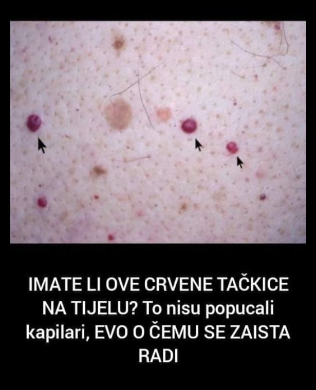 Šta su crvene izbočine na koži i kada treba obratiti pažnju?