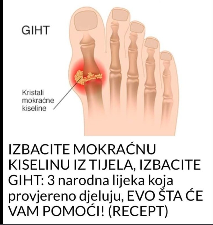 🧬 Kako prirodno smanjiti nivo mokraćne kiseline u telu i ublažiti bolove u zglobovima